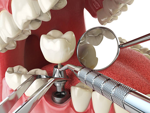 Best Lost Filling or Crown Replacement in Belington, WV